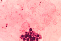 Лечение амилоидоза в Израиле Лечение амилоидоза в Израиле