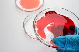 Лечение эритроплазии Кейра в Израиле Лечение эритроплазии Кейра в Израиле