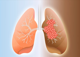 Избыточное потребление витаминов группы B приводит к карциноме легких Избыточное потребление витаминов группы B приводит к карциноме легких